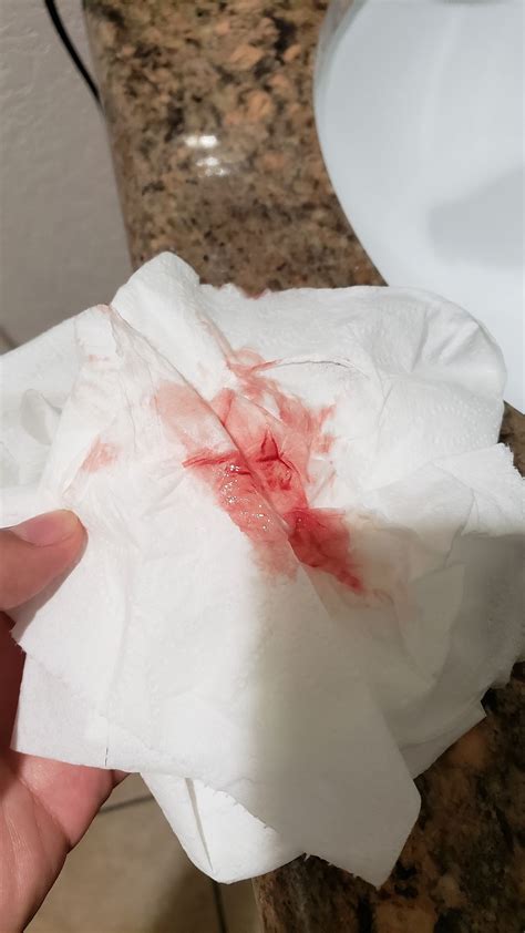 implantation bleeding at 12dpo|real photos of implantation bleeding.